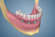 Two Immediate Load Implants with Metal Posts